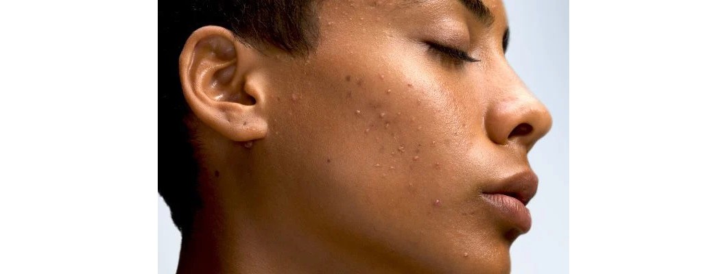 What you need to know about acne