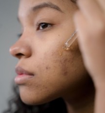 A Comprehensive Guide for using Azelaic Acid in Skincare