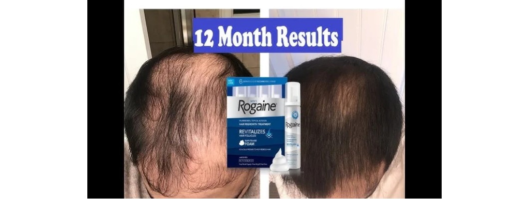 The Benefits and Uses of Minoxidil for Men and Women