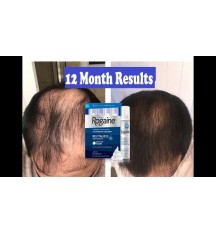 The Benefits and Uses of Minoxidil for Men and Women