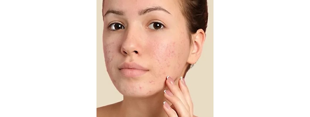 Benzoyl Peroxide: Deciphering the Acne-Fighting Powerhouse