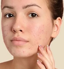 Benzoyl Peroxide: Deciphering the Acne-Fighting Powerhouse