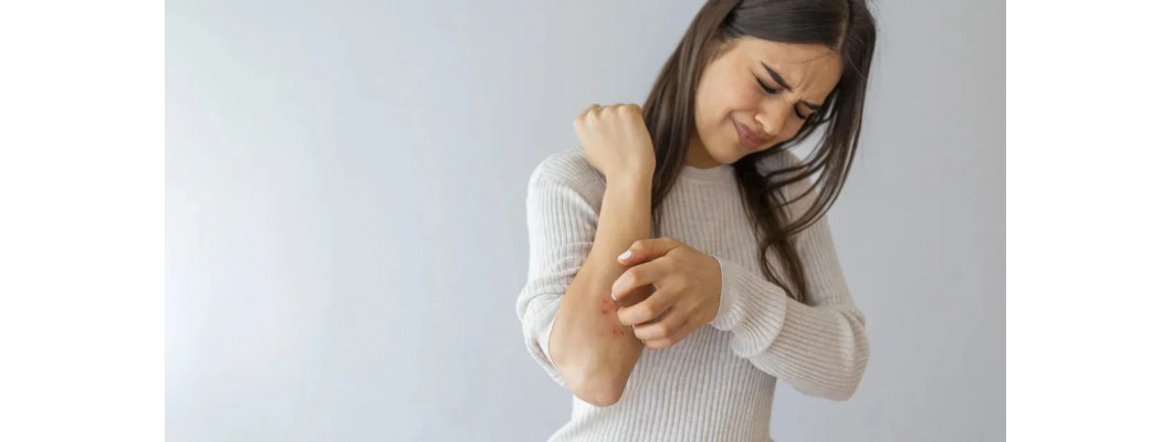 How to Manage Eczema (Atopic Dermatitis)