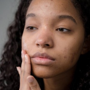 Salicylic Acid: Unveiling the Gentle Giant of Acne Fighters