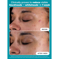 Paula's Choice Salicylic Acid 2% Bha Exfoliant 30ml