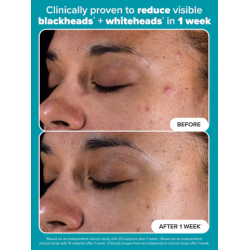 Paula's Choice Salicylic Acid 2% Bha Exfoliant 30ml