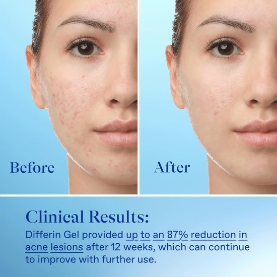 Differin Acne Treatment Gel with Adapalene 0.1% 15g